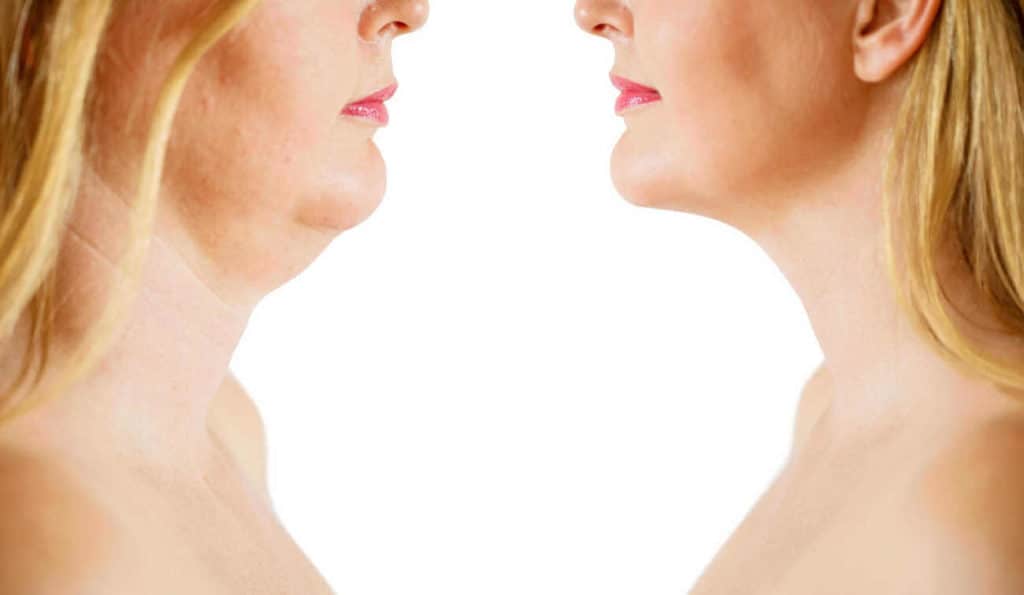 Double Chin treatment Hounslow West before and after results