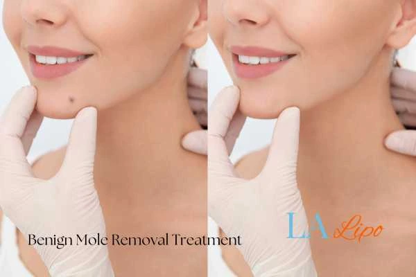 woman's before and after mole removal Hounslow West results