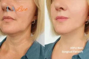 hi-fu for wrinkles Hounslow West before and after results