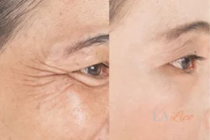 Before and after results of woman - HI-fu wrinkles reduction treatment Hounslow West