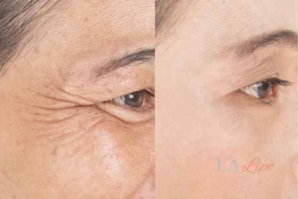 Before and after results of woman - HI-fu wrinkles reduction treatment Hounslow West