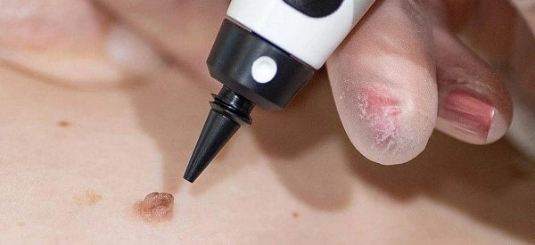skin tag removal using cryopen Hounslow West