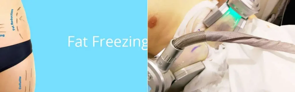 Fat freezing Hounslow West on multiple areas of the body
