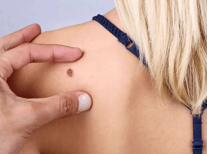 woman having mole removal Hounslow West consultation before treatment.