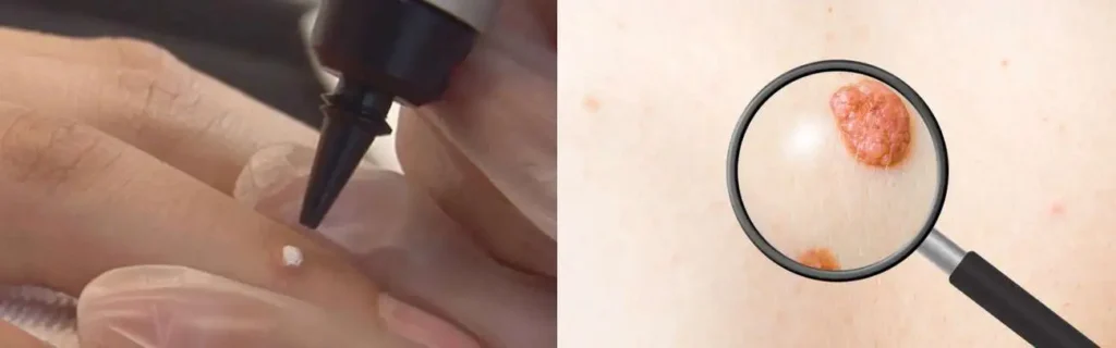 Cryopen for mole removal Hounslow West - speak to our team today!