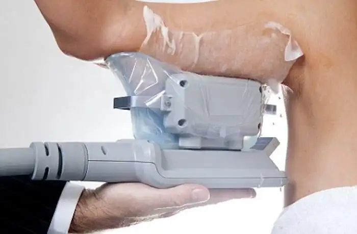 Picture of fat freezing Hounslow West on the upper arms.