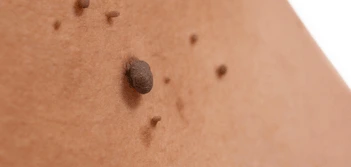 image of a skin tag Hounslow West