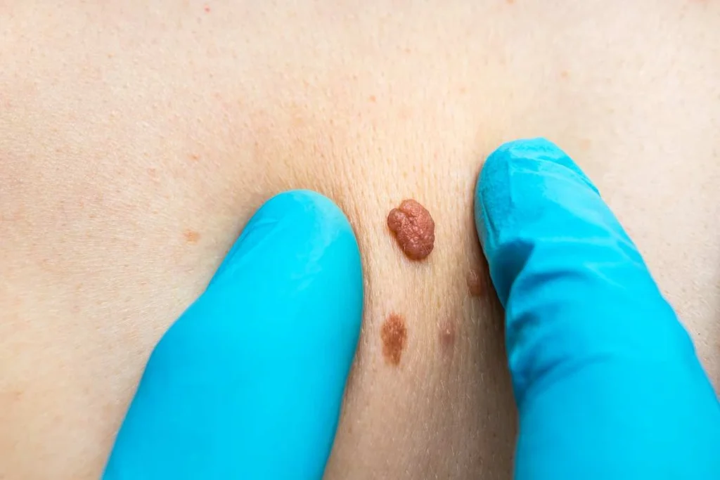 Consultant examining a skin tag Hounslow West