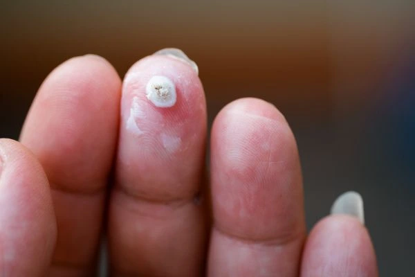 wart on person finger - cryotherapy to treat from LA LIPO Hounslow West