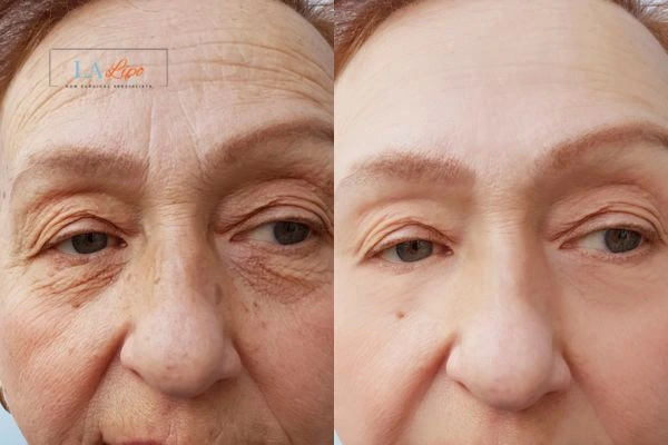 The powerful benefits of Morpheus8 Treatment Hounslow West - Call Our team today!