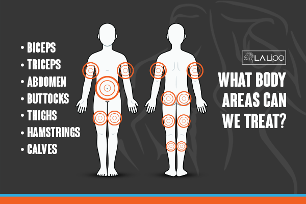 Diagram to show areas you can have LA-EMS Body Sculpting Treatment Hounslow West