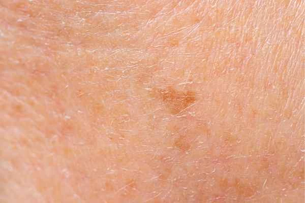 close up picture of age spots Hounslow West